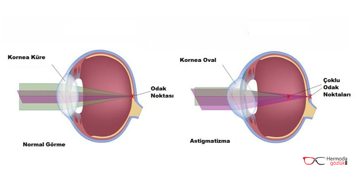 Normal Görme ve Astigmatizma Odak Noktaları