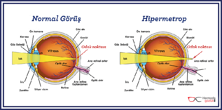 Normal Görüş ve Hipermetrop Göz Yapısı Karşılaştırması