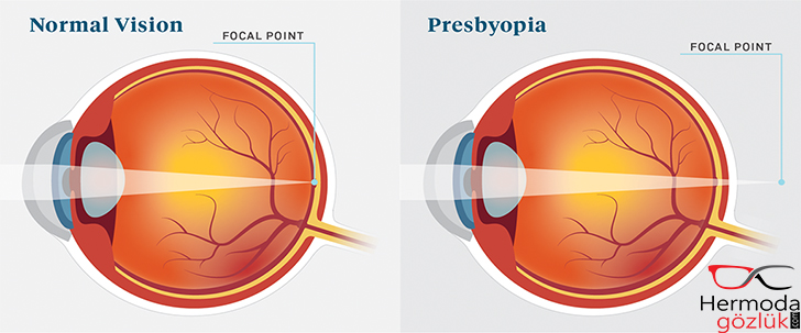 Presbiyopi Nedir - Hermoda Gözlük