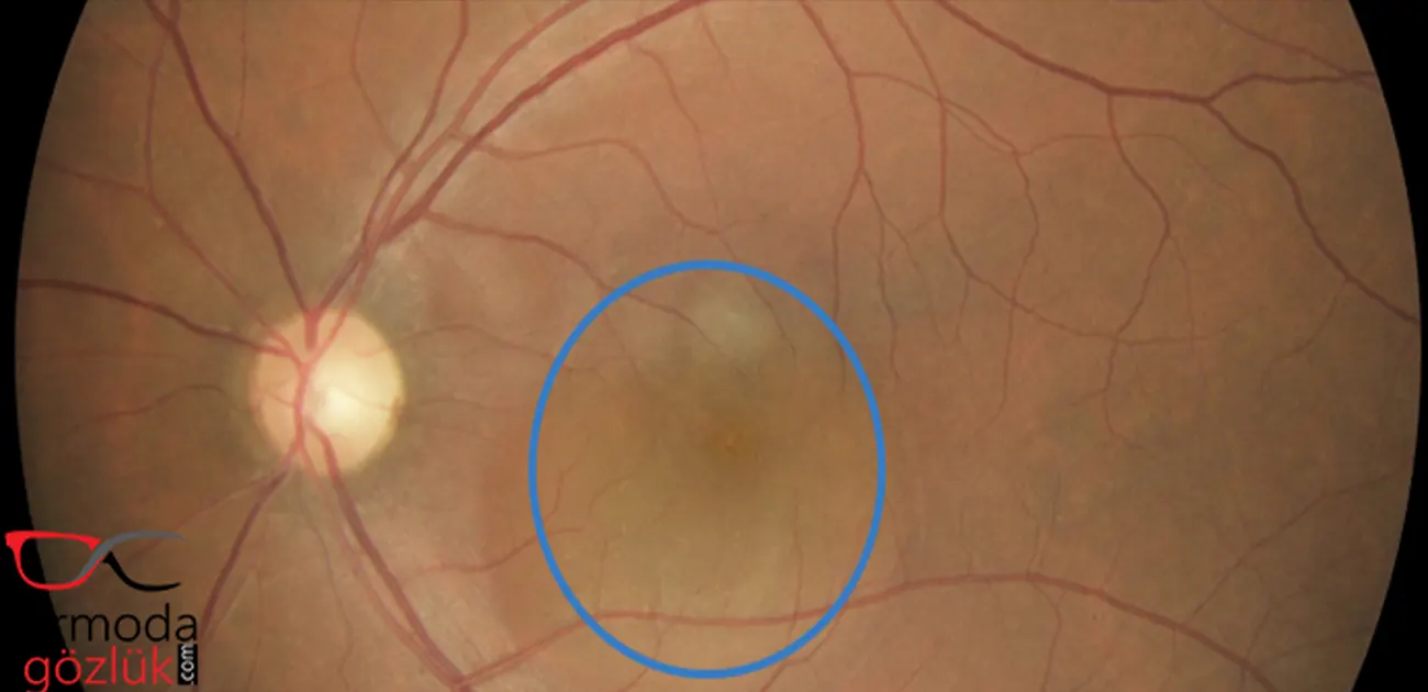 Santral Seröz Retinopati Göz Arkası Fundus Muayenesi