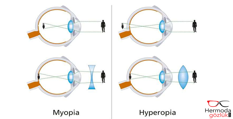 Çocuklarda Miyop ve Hipermetrop - Hermoda Gözlük