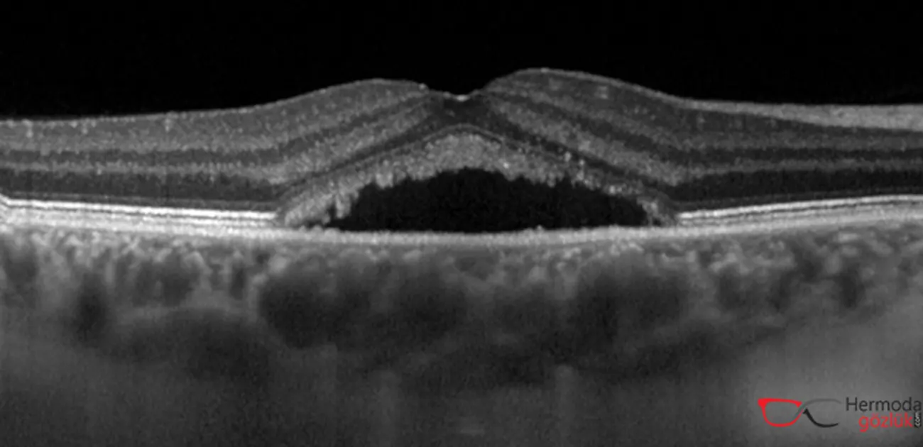 Santral Seröz Retinopati Retina Altı Sıvı Birikimi OCT Kesiti
